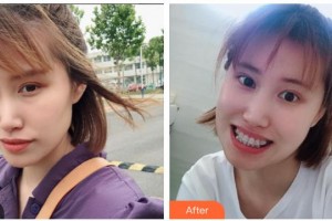 瀘州碧特牙科醫(yī)院周丕立整形價格表附金屬托槽矯正案例展示