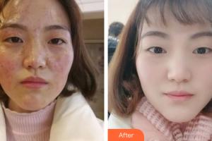 深圳景田醫(yī)院整形美容中心鄧銳整形價(jià)格表附綜合祛斑案例展示