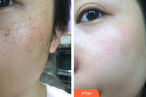 深圳福華中西醫(yī)結(jié)合醫(yī)院醫(yī)學(xué)美容科李碧容整形價(jià)格表附超激光美膚+祛斑針案例展示