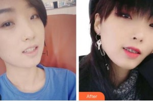 德陽德美醫(yī)療美容門診部蔣克鋒整形價格表附金屬托槽矯正案例展示