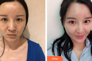 深圳同仁醫(yī)療美容醫(yī)院蘇英整形價(jià)格表附自體脂肪面部填充案例展示