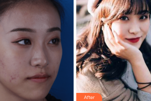 深圳和協(xié)門診部整形美容科何杰整形價(jià)格表附清潔祛痘案例展示