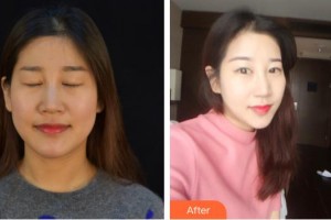 德陽金榮醫(yī)療美容專科醫(yī)院沈軍國整形價格表附熱瑪吉案例展示