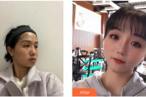 德陽金榮醫(yī)療美容?？漆t(yī)院吳沙冰整形價格表附埋線提升案例展示