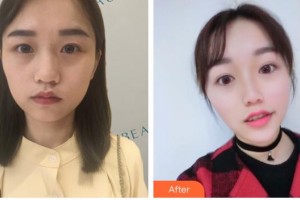 德陽德美醫(yī)療美容門診部王俸祺整形價格表附熱瑪吉案例展示