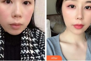 德陽金榮醫(yī)療美容?？漆t(yī)院邊森整形價(jià)格表附鼻部綜合案例展示