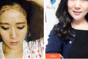 德陽德美醫(yī)療美容門診部于洲戡整形價(jià)格表附種植發(fā)際線案例展示