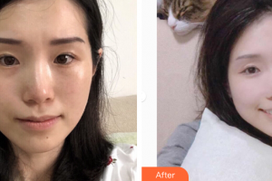 深圳鵬愛秀琪醫(yī)療美容醫(yī)院劉亞慧整形價格表附白瓷娃娃案例展示