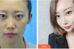 德陽德美醫(yī)療美容門診部張莉整形價(jià)格表附埋線提升案例展示