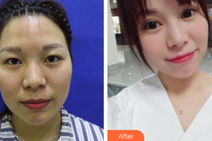 深圳鵬愛秀琪醫(yī)療美容醫(yī)院薛林兵整形價格表附全切雙眼皮案例展示