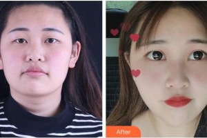 德陽德美醫(yī)療美容門診部袁世良整形價(jià)格表附眼部綜合案例展示