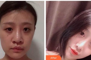 德陽德美醫(yī)療美容門診部王亞國整形價(jià)格表附鼻部綜合案例展示