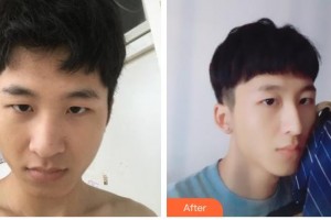 德陽東美醫(yī)療美容整形門診部鐘正強(qiáng)整形價(jià)格表附鼻部綜合案例展示