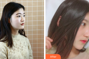 深圳艾妍醫(yī)療美容門診部楊曉楠整形價(jià)格表附鼻部手術(shù)案例展示