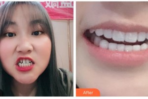 德陽維樂新橋口腔門診部劉詩奇整形價(jià)格表附冷光美白案例展示