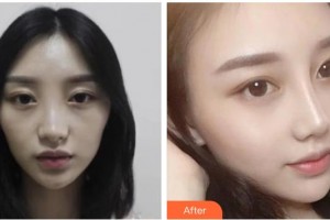 綿陽煌佳醫(yī)學(xué)美容診所曹喜蓉整形價(jià)格表附鼻部綜合案例展示