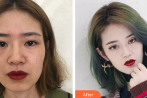 深圳臻瑞芝美醫(yī)療美容門診部周偉整形價格表附切開雙眼皮+倒睫矯正案例展示