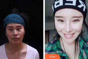 綿陽煌佳醫(yī)學(xué)美容診所范莉整形價(jià)格表附耳軟骨復(fù)合隆鼻案例展示