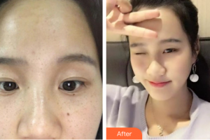 深圳新興皮膚病專科門診部方梅君整形價格表附祛雀斑案例展示