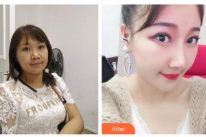 綿陽煌佳醫(yī)學(xué)美容診所李忠永整形價(jià)格表附鼻中隔軟骨隆鼻案例展示