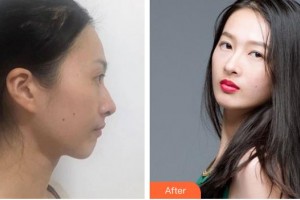 綿陽第三人民醫(yī)院醫(yī)療美容科廖小川整形價(jià)格表附鼻部綜合案例展示