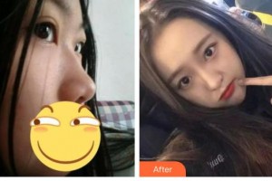 綿陽協(xié)和醫(yī)院醫(yī)學(xué)美容中心孟春麗整形價(jià)格表附肋軟骨隆鼻案例展示