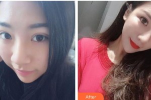 綿陽整形美容醫(yī)院王步禮整形價(jià)格表附鼻部綜合案例展示