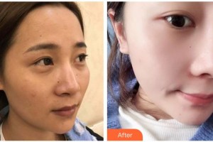 綿陽中心醫(yī)院醫(yī)學(xué)美容科周竹梅整形價(jià)格表附鼻部綜合案例展示