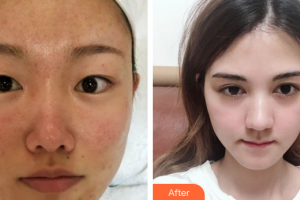 深圳多米勒醫(yī)療美容門診部周春峰整形價格表附微針嫩膚案例展示