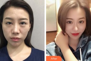 綿陽中心醫(yī)院醫(yī)學(xué)美容科周平武整形價(jià)格表附鼻部綜合案例展示