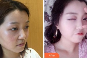 綿陽中心醫(yī)院醫(yī)學(xué)美容科趙平武整形價(jià)格表附鼻部綜合案例展示