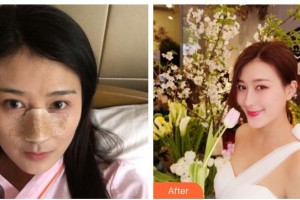 綿陽中心醫(yī)院醫(yī)學(xué)美容科杜永忠整形價(jià)格表附鼻部綜合案例展示