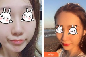 綿陽中心醫(yī)院醫(yī)學(xué)美容科劉小意整形價(jià)格表附無針?biāo)獍咐故?>
</a>
<h3 class=