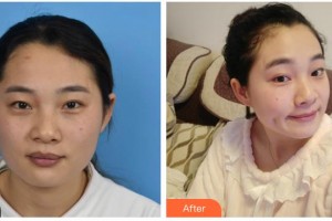 綿陽口腔醫(yī)院整形美容科彭澤勛整形價(jià)格表附光子嫩膚案例展示