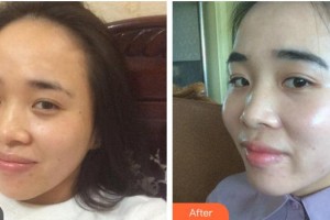 綿陽茗匯醫(yī)療美容醫(yī)院吳承勇整形價(jià)格表附光子嫩膚案例展示