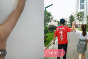 深圳腋秀腋臭醫(yī)院余漢萍整形價格表附去狐臭案例展示