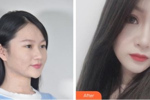 綿陽茗匯醫(yī)療美容醫(yī)院裴亮整形價(jià)格表附眼部綜合案例展示