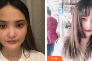 綿陽東美奧拉克醫(yī)療美容門診部盧元剛整形價(jià)格表附耳軟骨復(fù)合隆鼻案例展示