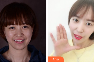 深圳友睦口腔門診部陳鋼整形價格表附時代天使隱形矯正案例展示