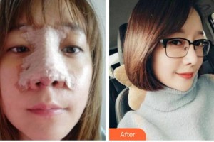 綿陽東美奧拉克醫(yī)療美容門診部周雪整形價(jià)格表附鼻部綜合案例展示