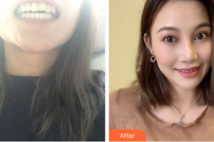 深圳友睦口腔門診部時春宇整形價格表附半隱形矯正案例展示