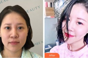 綿陽愛爾眼科醫(yī)院王曉莉整形價(jià)格表附熱瑪吉案例展示