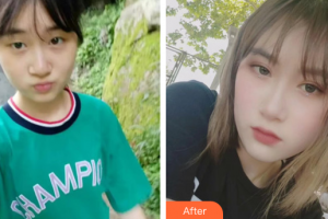 深圳美顏醫(yī)療美容門診部范開防整形價格表附雙眼皮案例展示