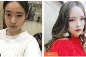 綿陽愛爾眼科醫(yī)院趙定中整形價(jià)格表附切開雙眼皮案例展示