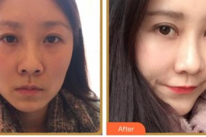 綿陽愛爾眼科醫(yī)院蘇林整形價(jià)格表附眼部綜合案例展示