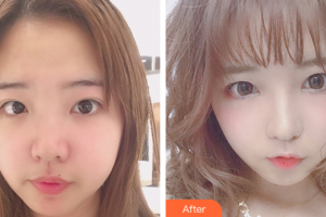 深圳心悅醫(yī)療美容門診部劉曉明整形價格表附眼部整形案例展示