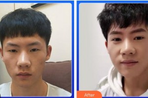 綿陽愛爾眼科醫(yī)院魯齊整形價(jià)格表附切開雙眼皮案例展示