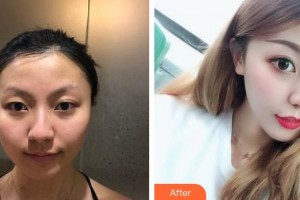 綿陽萬江眼科醫(yī)院張由良整形價(jià)格表附上眼瞼去脂案例展示