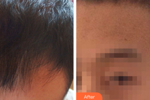 深圳華悅醫(yī)療美容門診部宋金錫整形價格表附種植發(fā)際線案例展示