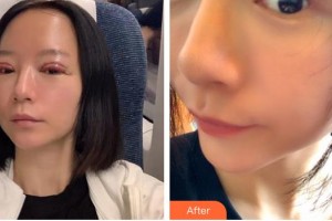 廣元市第二人民醫(yī)院醫(yī)療美容科王懷奇整形價(jià)格表附切開雙眼皮案例展示